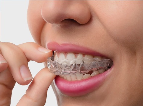 SE Calgary Invisalign | East Dental Care | SE Calgary Dentist