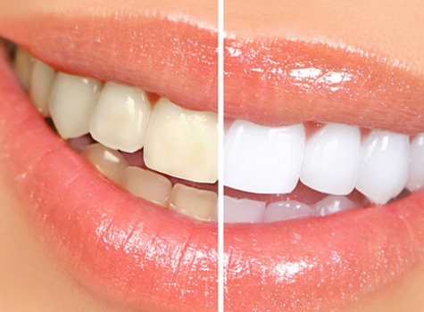 Se Calgary Teeth Whitening | East Dental Care | SE Calgary Dentist