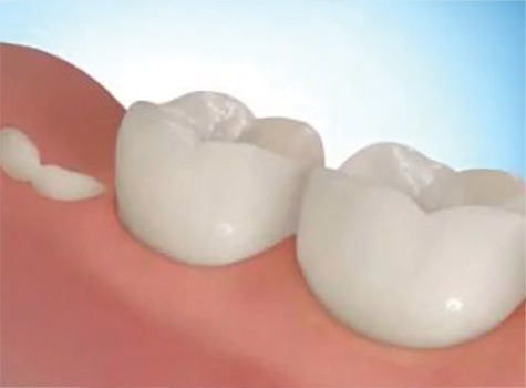 SE Calgary Wisdom Teeth Extractions | East Dental Care | SE Calgary Dentist