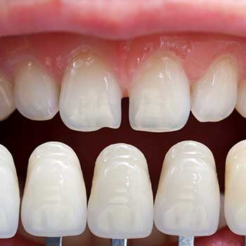 Composite Veneers East Dental Care | General Dentist | 17 Ave SE | Calgary