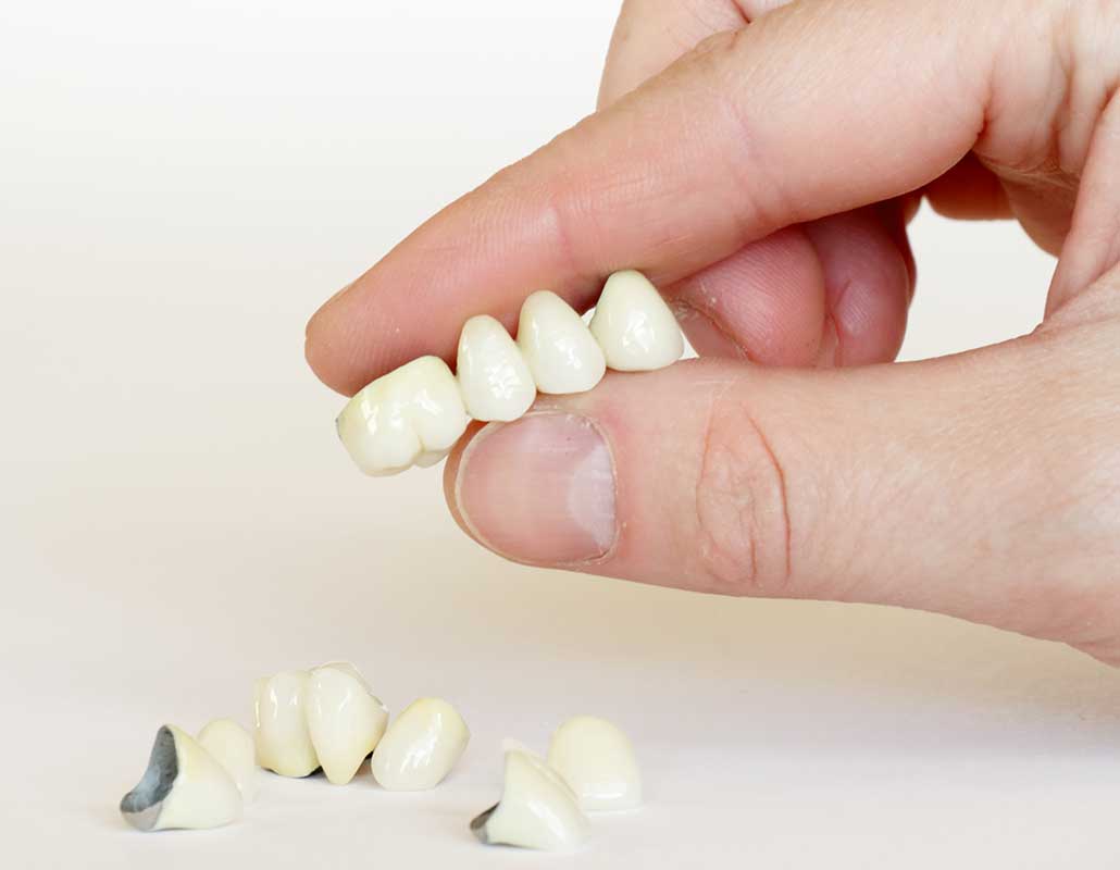 Calgary Dental Bridges | East Dental Care | Calgary Dentist | Calgary AB