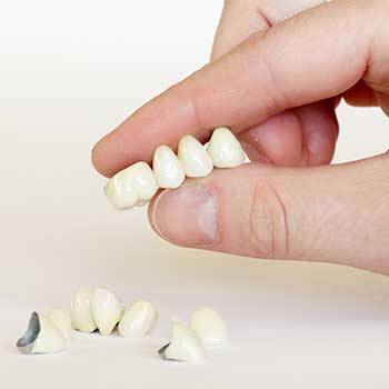 Calgary Dental Bridges | East Dental Care | Calgary Dentist | 17 Ave SE Calgary