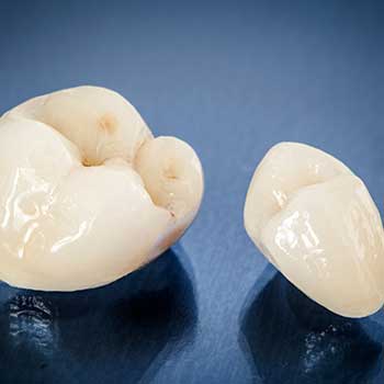 Dental Crowns Calgary | East Dental Care | General Dentist | 17 Ave SE Calgary