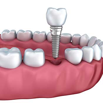 Calgary Dental Implant | East Dental Care | General Dentist | 17 Ave SE Calgary