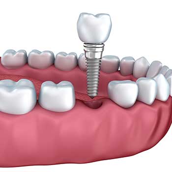 Dental Implant East Dental Care | General Dentist | 17 Ave SE | Calgary