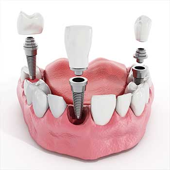 Calgary Dental Implant | East Dental Care | General Dentist Calgary