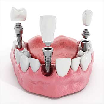 Dental Implant | East Dental Care | General Dentist | 17 Ave SE | Calgary