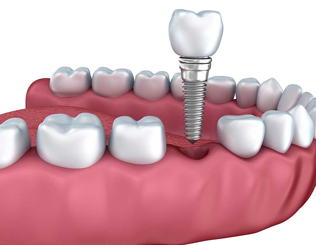 Dental Implants East Dental Care | General Dentist | 17 Ave SE | Calgary