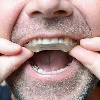 Calgary Night Mouth Guard | East Dental Care | General Dentist | 17 Ave SE Calgary
