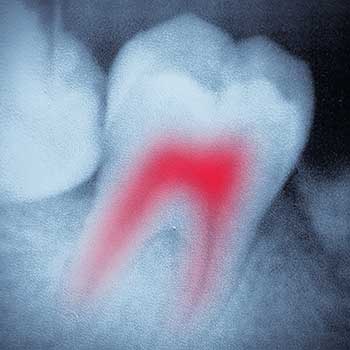 Root Canal Therapy | East Dental Care | Genreal Dentist | 17 Ave SE | Calgary