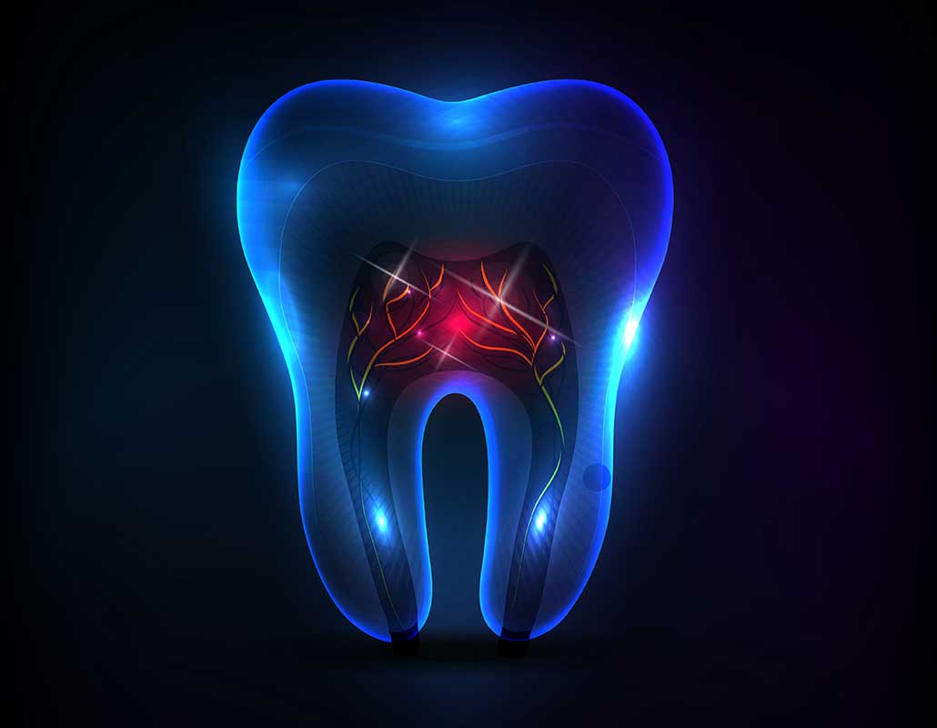 Root Canal Therapy East Dental Care | General Dentist | 17 Ave SE | Calgary