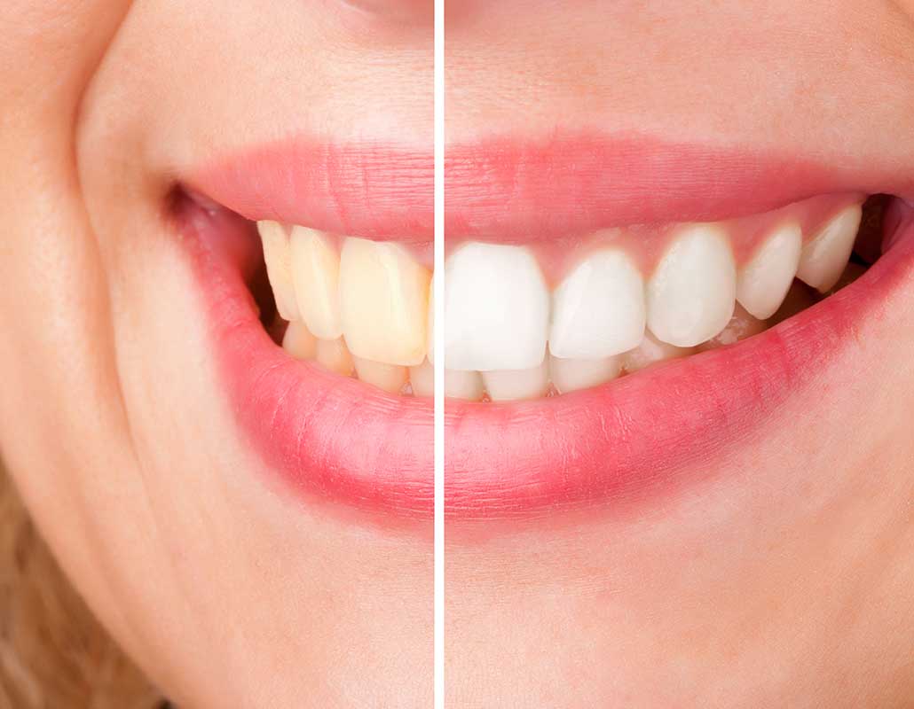 Teeth Whitening East Dental Care | General Dentist | 17 Ave SE | Calgary