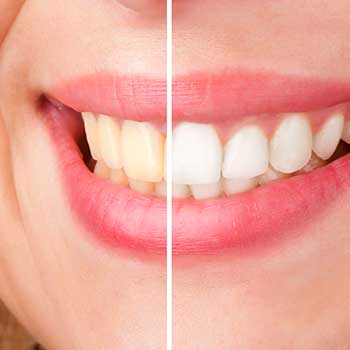 Teeth Whitening East Dental Care | General Dentist | 17 Ave SE | Calgary