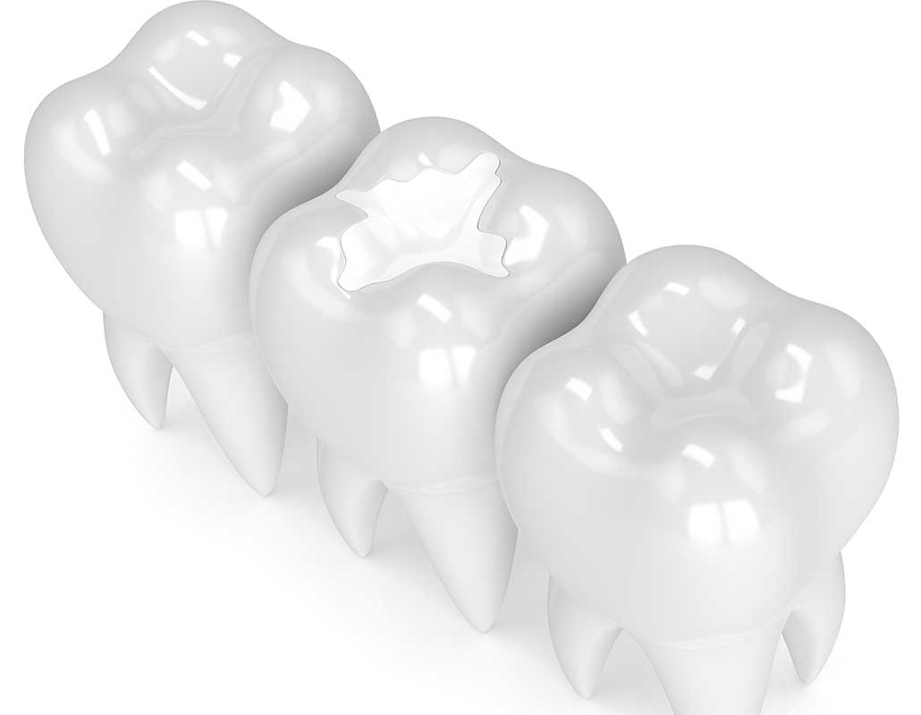 Calgary White Fillings | East Dental Care | General Dentist Calgary