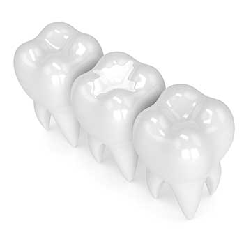 Calgary White Fillings | East Dental Care | Calgary Dentist | 17 Ave SE Calgary