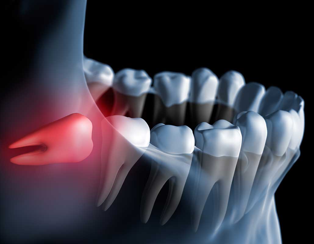 Calgary Wisdom Teeth Extraction | East Dental Care | General Dentist Calgary