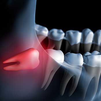 Calgary Wisdom Teeth Extractions | East Dental Care | 17 Ave SE Calgary
