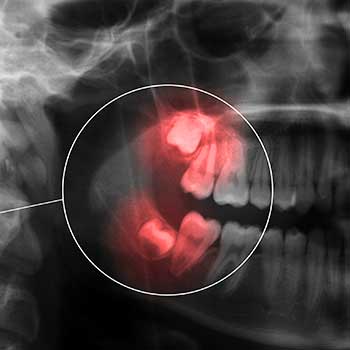 Calgary Wisdom Teeth Extractions | East Dental Care | General Dentist | Calgary AB